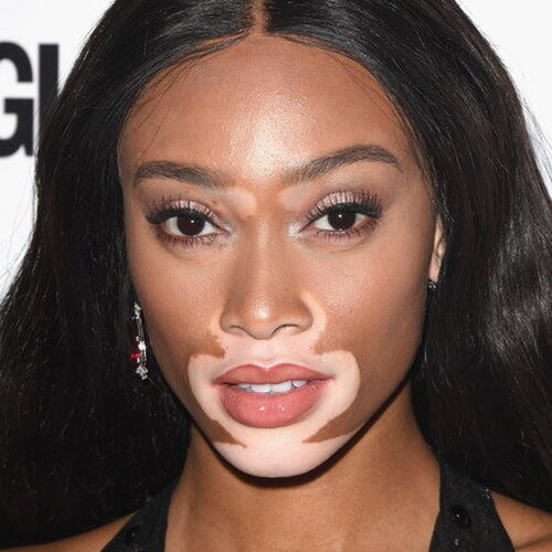Winnie Harlow